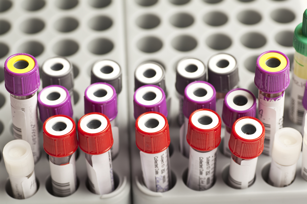 Veterinary blood test sample vials with colored caps for diagnostic lab work.